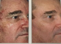 nano laser peel before/after