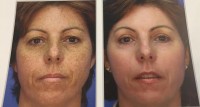 nano laser peel results before/after